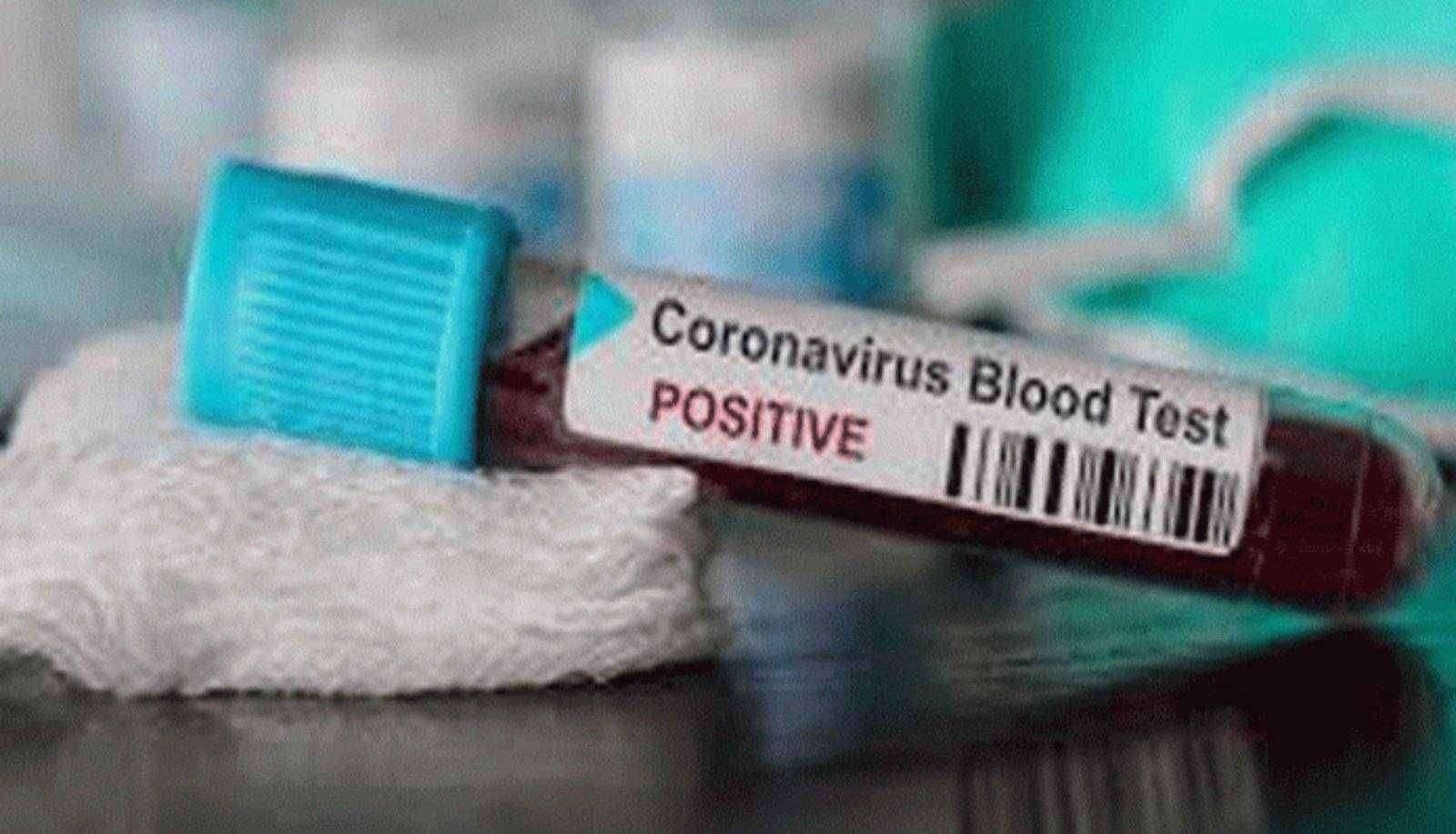 अमळनेर आज आढळले ७८ कोरोना बाधित तर १०२ रुग्ण झाले कोरोनामुक्त..