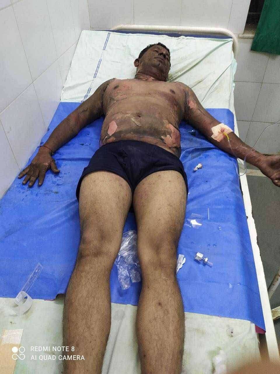 धक्कादायक.....साळवा येथे जितेंश पारधी(चव्हान)या युवकास सासरे व त्यांच्या नातेवाईक कडुन जिवंत जाळुन मारण्याचा प्रयत्न....!