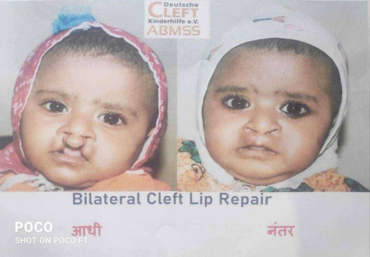 पंढरपूरचे सुप्रसिद्ध डॉ. शीतल के. शहा यांनी दुभंगलेले ओठ आणि टाळू नसलेले लहान बालकांच्या शस्त्रक्रिया आणल्या मोफत