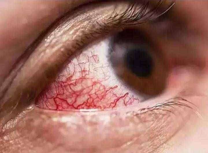 ? धक्कादायक! औरंगाबादमध्ये म्युकरमायकोसिसचे ५३ बळी...