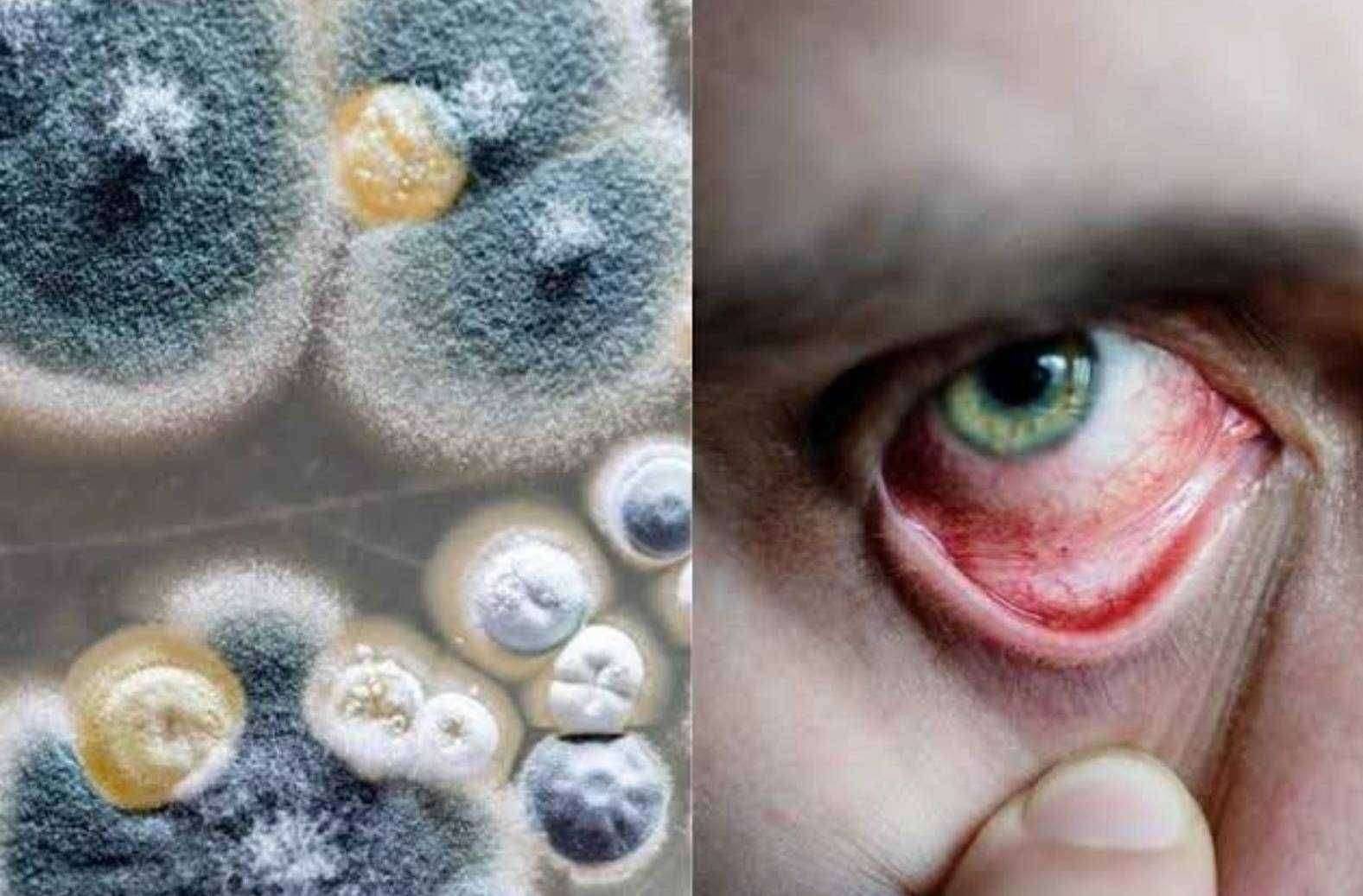 ?महत्वाचे... जाणून घ्या म्युकरमायकोसिस आजाराची काय आहेत लक्षणे..!AIMS ने जाहीर केली नियमावली..!