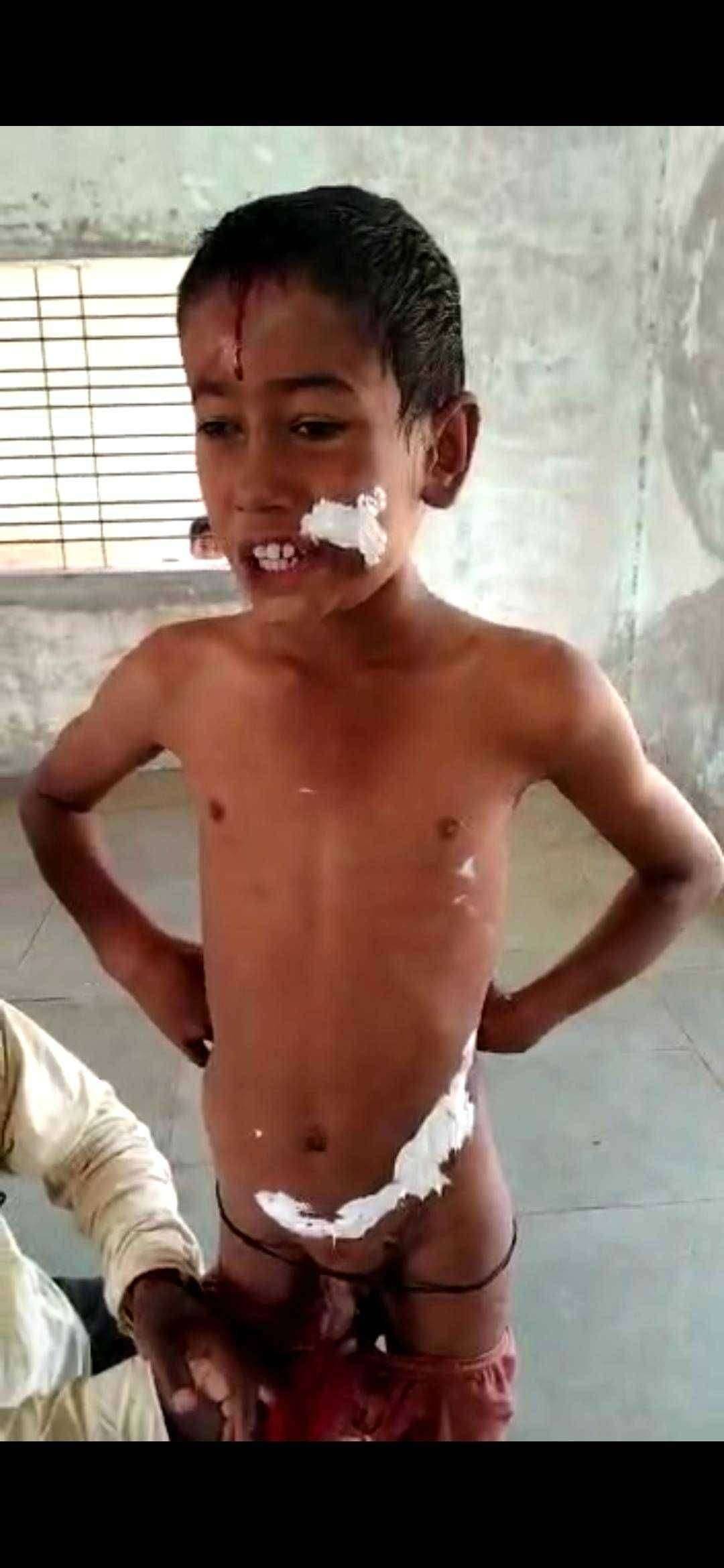 ? संतापजनक दिंडोरीत सावत्र आईकडून मतिमंद मुलांचा क्रूर छळ, गुप्तांगाला दिले चटके