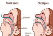 ?आरोग्याचा मुलमंत्र...स्लीप अ‍ॅप्निया..!लक्षणे आणि उपाय..!