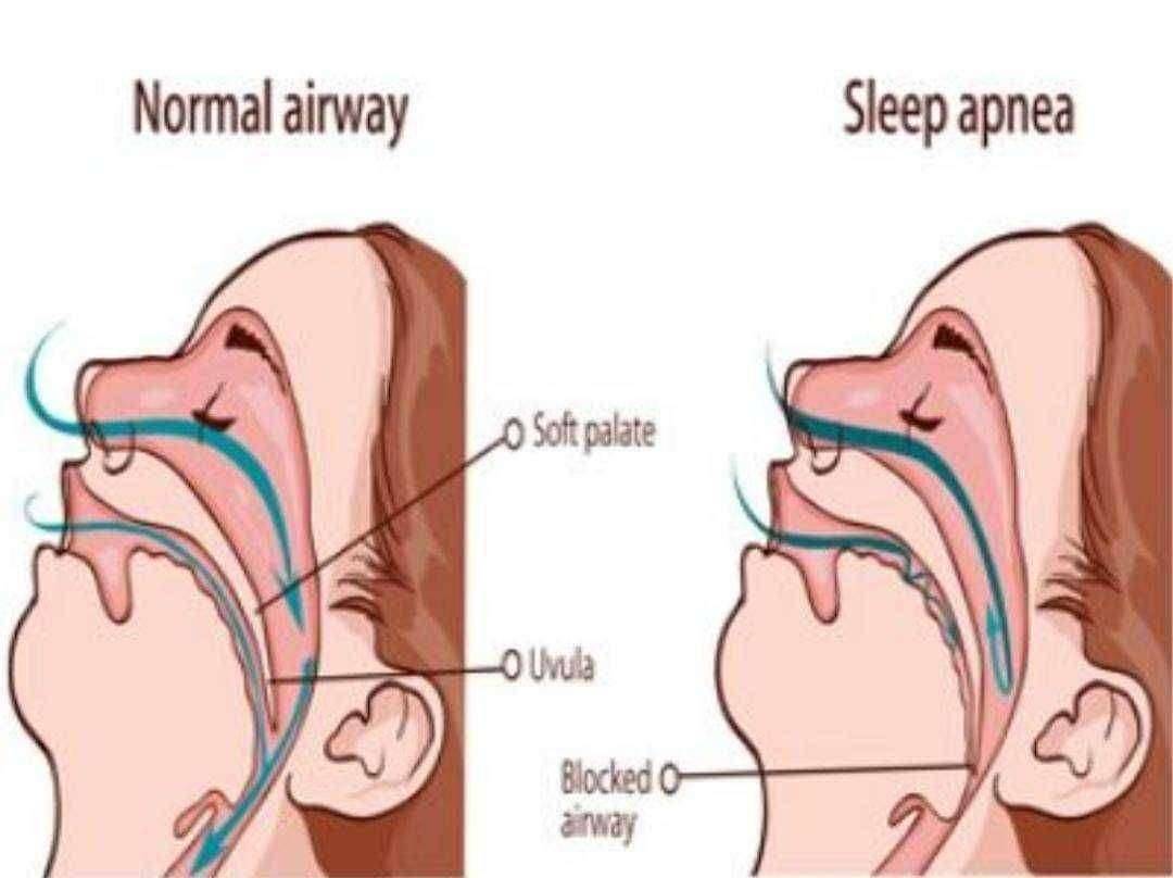 ?आरोग्याचा मुलमंत्र...स्लीप अ‍ॅप्निया..!लक्षणे आणि उपाय..!