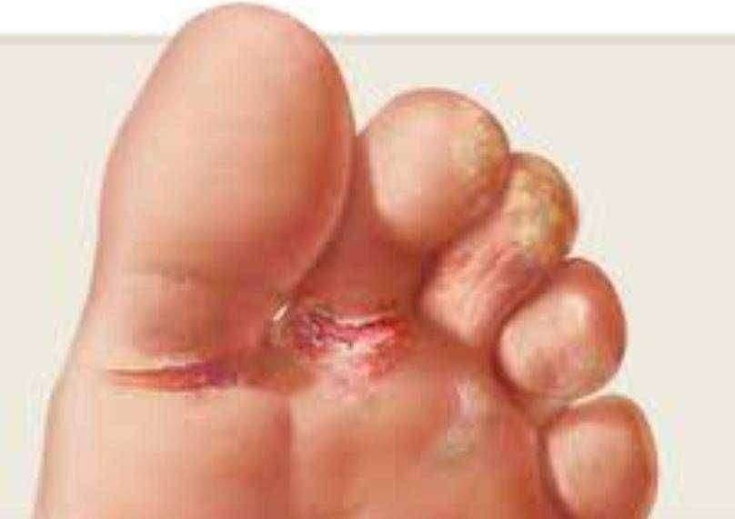 ?आरोग्याचा मुलमंत्र...पायांना चिखल्या झाल्यास करा हे सोपे घरगुती उपाय