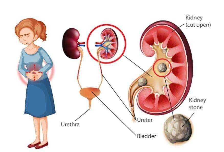 ? आरोग्य चा मुलमंत्र मुतखडा (Kidney stone) {करणे, लक्षणें व उपचार}
