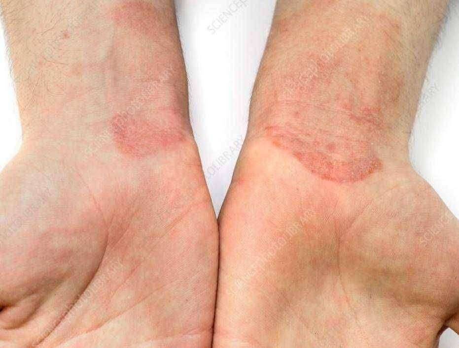 ?आरोग्याचा मुलमंत्र.... Dermatitis (त्वचेवर असलेली सुज)