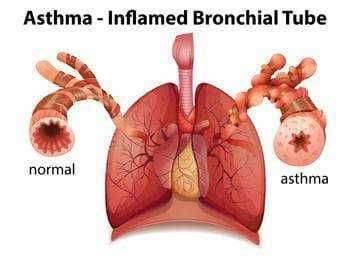 ? आरोग्याचा मुलमंत्र दमा (Asthma) लक्षणे, प्रकार व घ्यायची काळजी