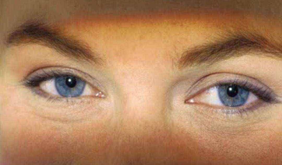 आरोग्याचा मुलमंत्र रातआंधळेपणा (Night blindness)