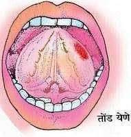 आरोग्याचा मुलमंत्र ....तोंड येणे (Mouth ulcer)