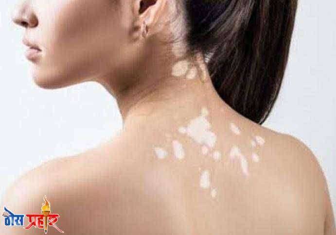आरोग्याचा मुलमंत्र....पांढरे डाग (कोड) कारणे लक्षणे व उपचार