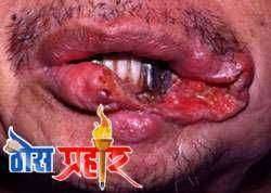 गुटखा खाणारे लोक ठरतात कर्करोगाचे बळी.! नंदुरबार बेघर संघर्ष समितीच्या वतीने कारवाईची...