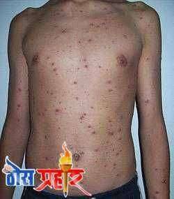 आरोग्या चा मुलमंत्र कांजण्या (लक्षणें, कारणे, उपचार)