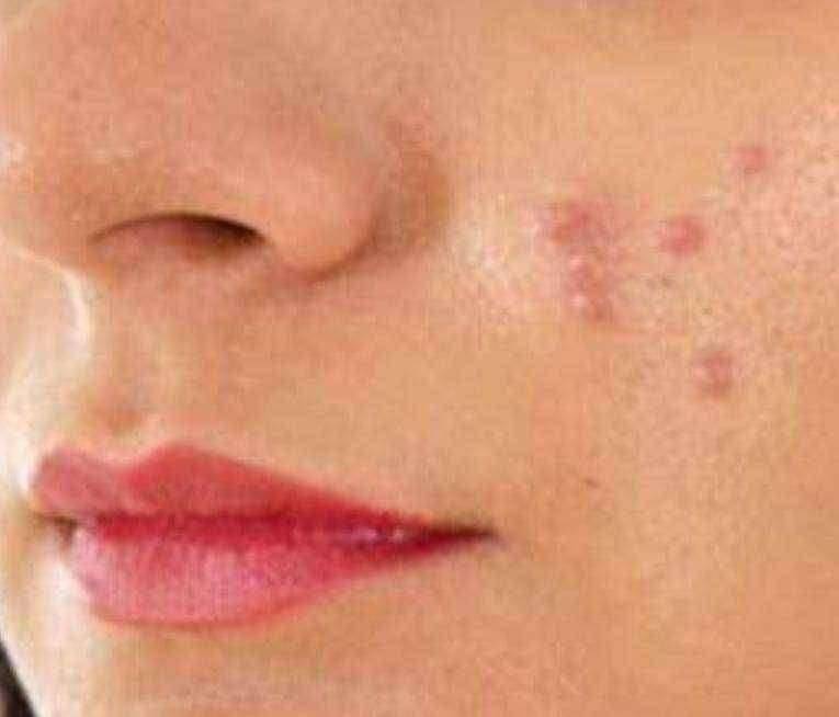 आरोग्या चा मुलमंत्र चेहऱ्या वरील पिंपल्स (मुरूम)