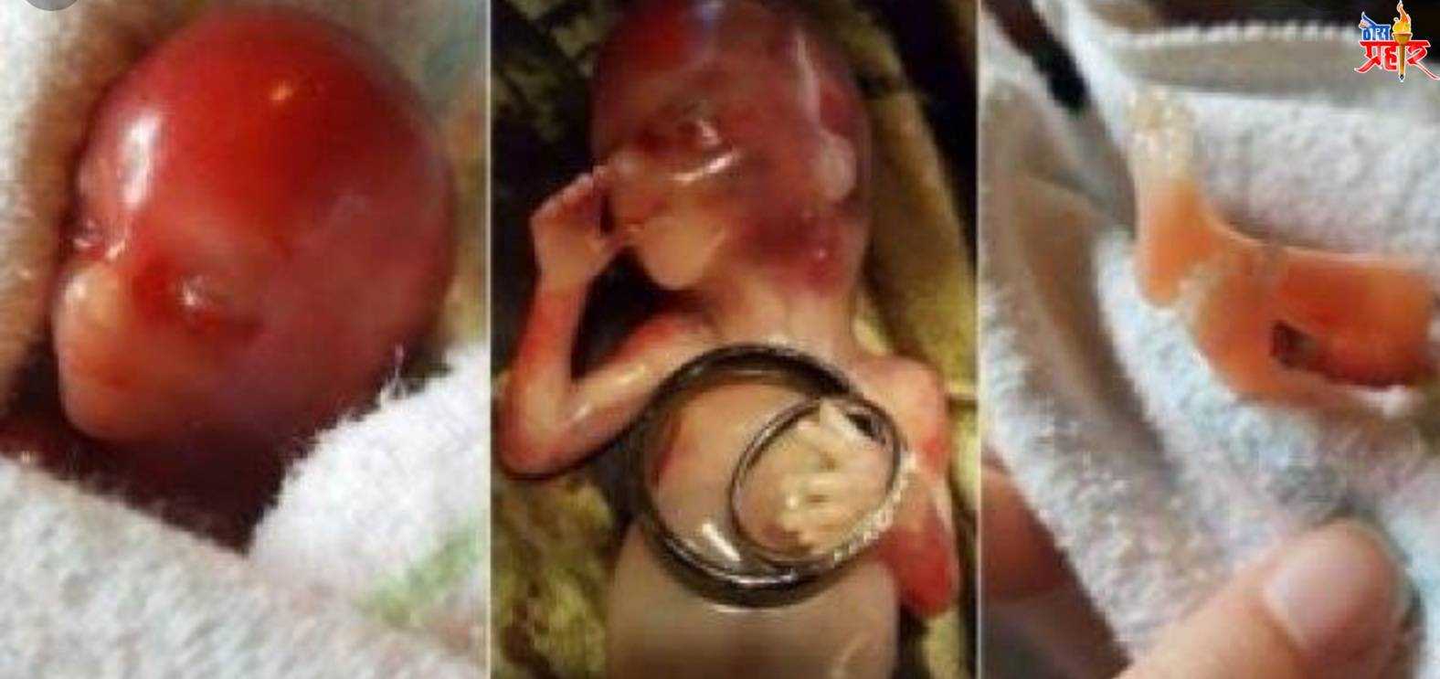 धक्कादायक...शिक्षकाचे प्रताप..मुलासाठी "इतक्या" वेळा करायला लावला पत्नीला गर्भपात...