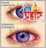 आरोग्या चा मुलमंत्र डोळे येणे (डोळ्यांचा संसर्ग) लक्षणं व काळजी