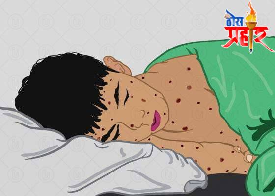 आरोग्याचा मुलमंत्र...कांजण्यांचे डाग घालवण्या साठी घरगुती उपचार