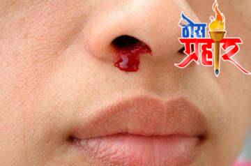 आरोग्याचा मुलमंत्र घोळणा फुटल्या वर (नाकातून रक्त आल्यावर) सोप्पे उपचार