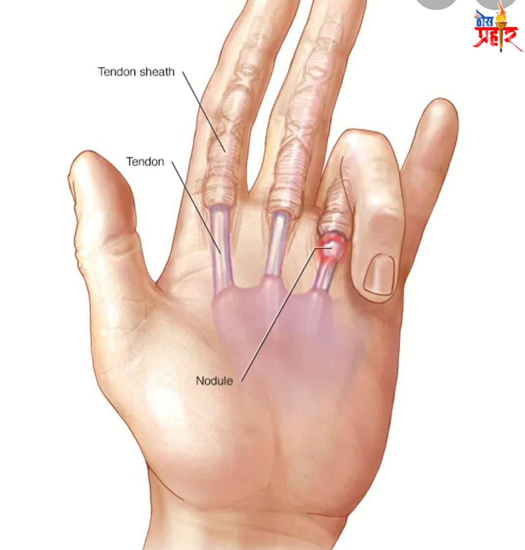 बोटं मोडताना आवाज का येतो ?