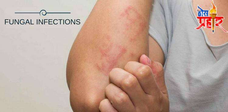 आरोग्याचा मुलमंत्र..फंगल (खाज) इन्फेकशन लक्षणें व उपाय