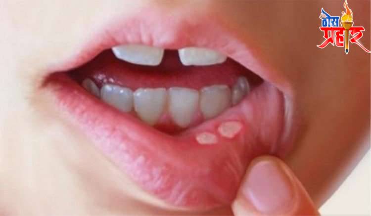 आरोग्याचा मुलमंत्र तोंड येणे (Mouth Ulcer) घरगुती उपचार