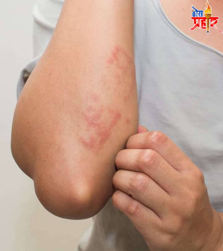 आरोग्याचा मुलमंत्र.. स्किन अँलर्जी (skin allergy) घरेलू उपचार