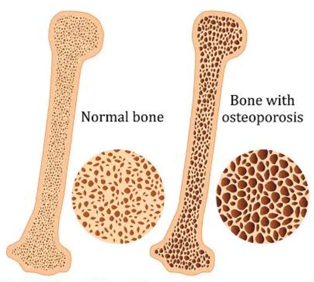 आरोग्याचा मुलमंत्र...अशी घ्या ठिसूळ हाडांची मजबूत काळजी