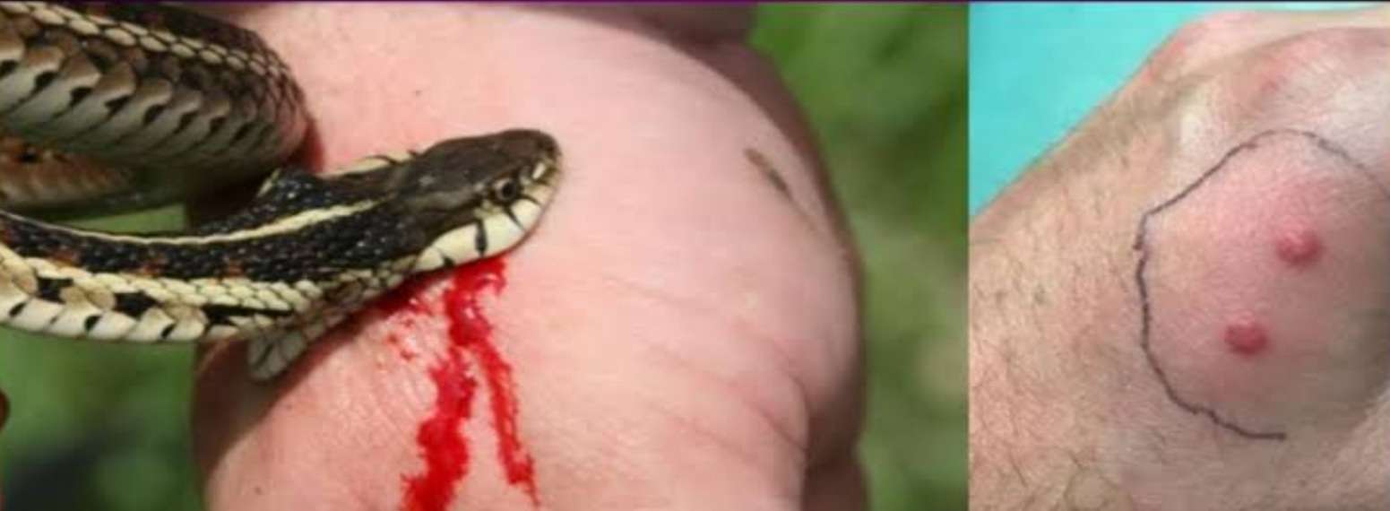 साप चावला..!घाबरू नका हे आहेत उपाय आणि उपचार..!