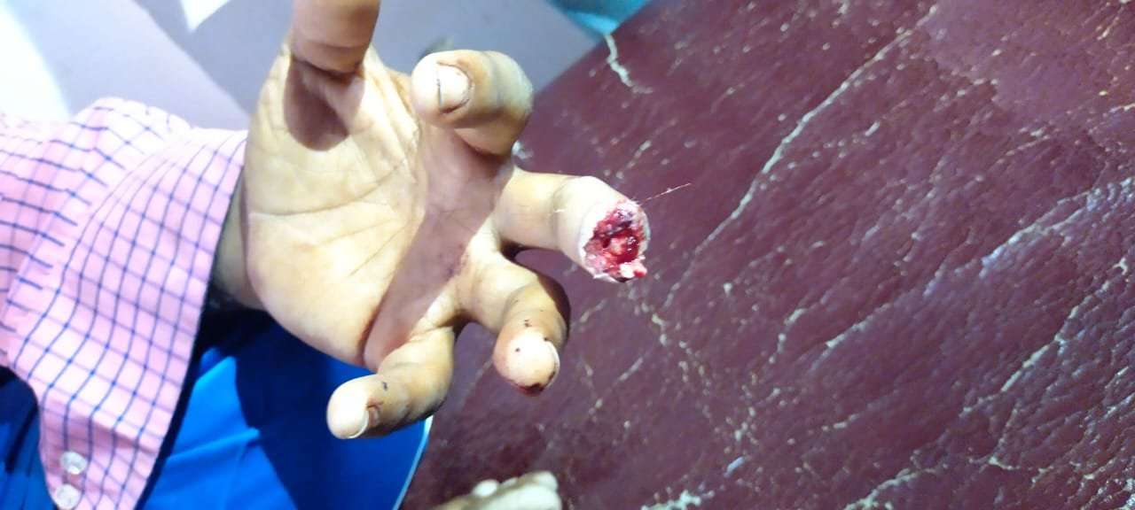 अमळनेर: दुकानातून घेतलेल्या वस्तूचे पैसे मागितले म्हणून दुकानदाराचे तोडले बोट..!