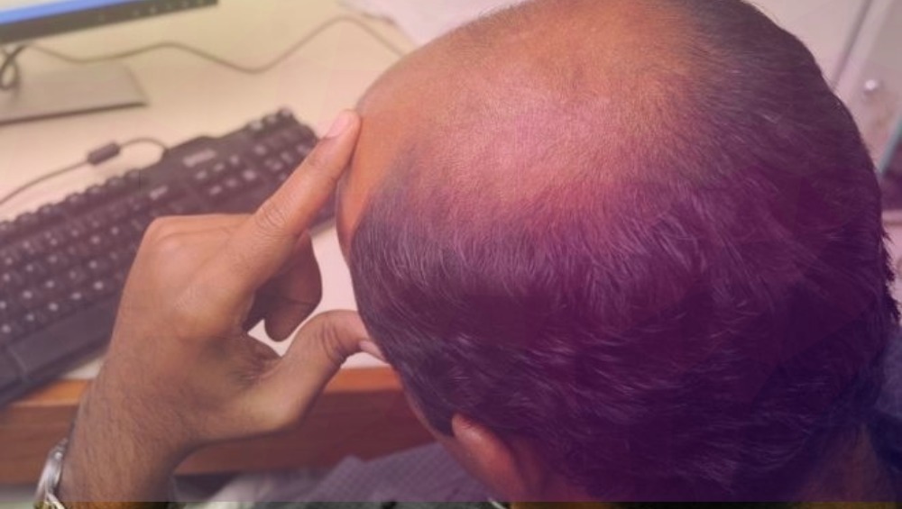 आरोग्याचा मुलमंत्र..केसांची निगा... टक्कला वर घरगुती उपाय