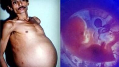 Amazing: अरे हो तो होता गरोदर... ऑपरेशन करताच जुळे आले बाहेर...